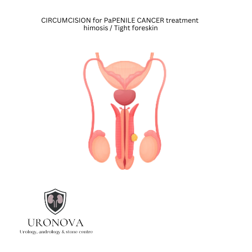 CIRCUMCISION for PaPENILE CANCER treatmenthimosis / Tight foreskin
